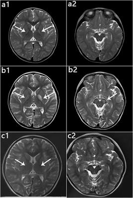 Corrigendum: Cinical, Metabolic, and Genetic Analysis and Follow-Up of Eight Patients With HIBCH Mutations Presenting With Leigh/Leigh-Like Syndrome